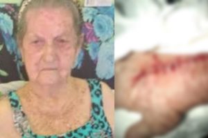 Idosa de 93 anos tem braço cortado por técnico ao retirar gesso em hospital do Rio