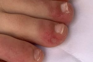 ‘Dedos de covid’ foi um dos sintomas observados – Foto: COVID-PIEL STUDY/via BBC