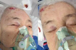 Família denuncia negligência após idosa com Covid-19 cair de leito em hospital