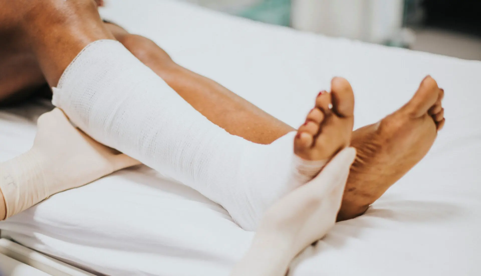 MULHER TEM 60% DO CORPO QUEIMADO