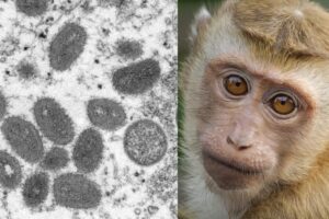 varíola dos macacos