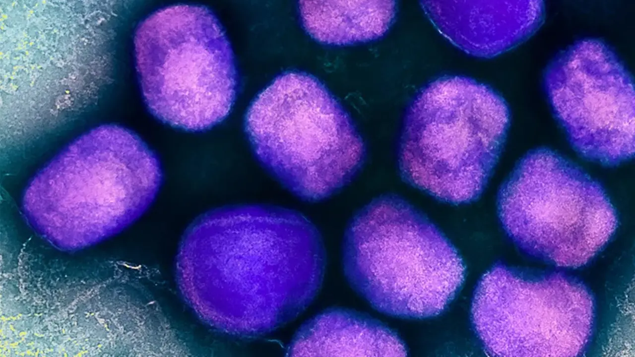 Primeiro caso suspeito de varíola dos macacos é registrado em Americana