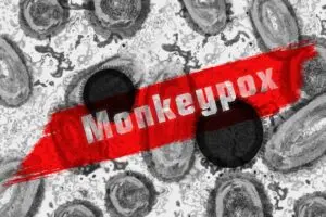 Varíola dos macacos pode apresentar lesões sutis e dificultar diagnóstico, dizem médicos