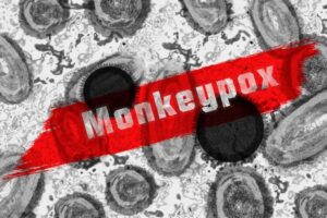 Limeira confirma 10º caso de monkeypox em Limeira