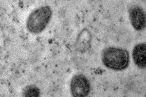 Limeira registra três novos casos suspeitos de varíola dos macacos
