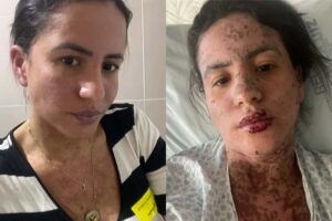 Esposa de Frank Aguiar ficou na UTI por doença rara de pele