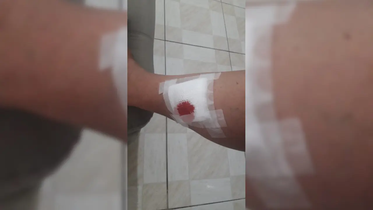 Idosa é mordida por cachorros soltos no Jardim Palmeiras, em Limeira
