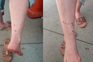 Mais uma mulher é atacada por cachorros soltos no Jardim Palmeiras, em Limeira