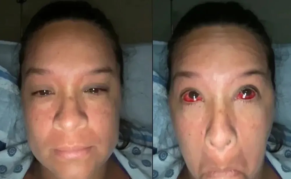 Segundo médicos, os vasos sanguíneos dos olhos da mulher literalmente explodiram.