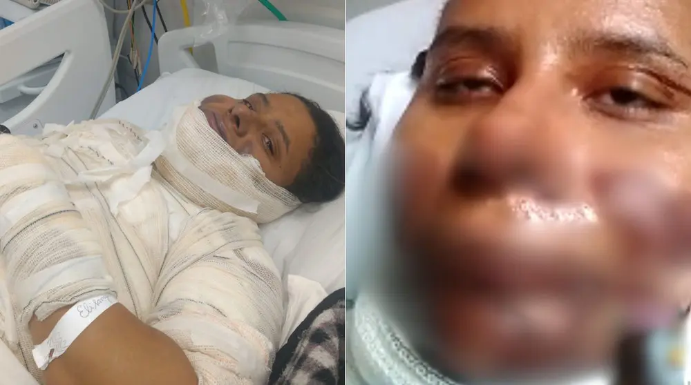 Fritando-ovo-mulher-sofre-queimadura-grave-fica-internada-e-morre-em-Limeira