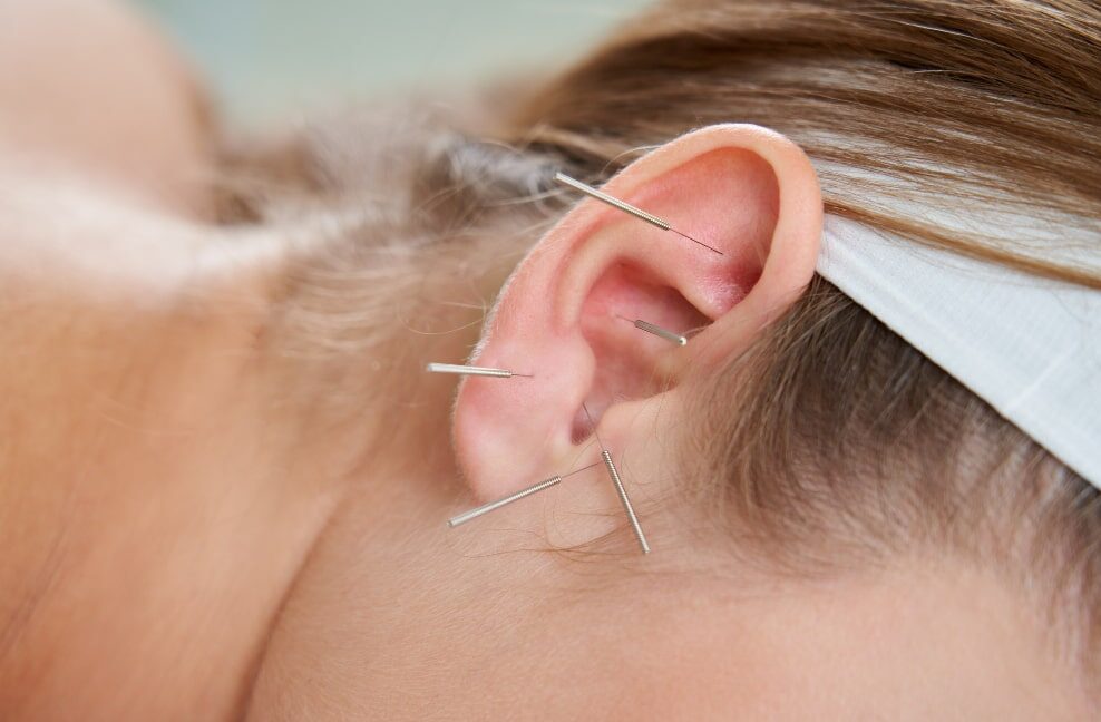 Estudo confirma benefício da acupuntura auricular no tratamento da depressão