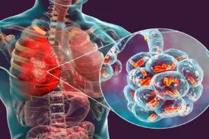 Pneumonia é uma das principais causas de internação hospitalar do mundo