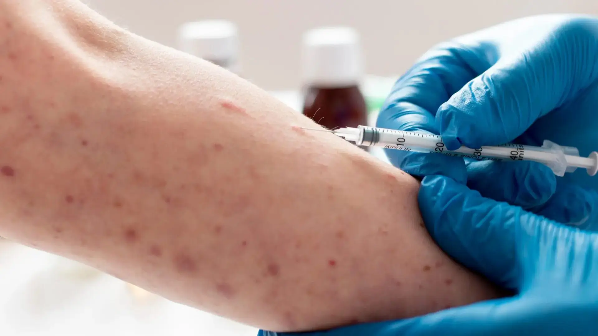 Mpox-conheca-sintomas-e-tire-principais-duvidas-sobre-a-doenca