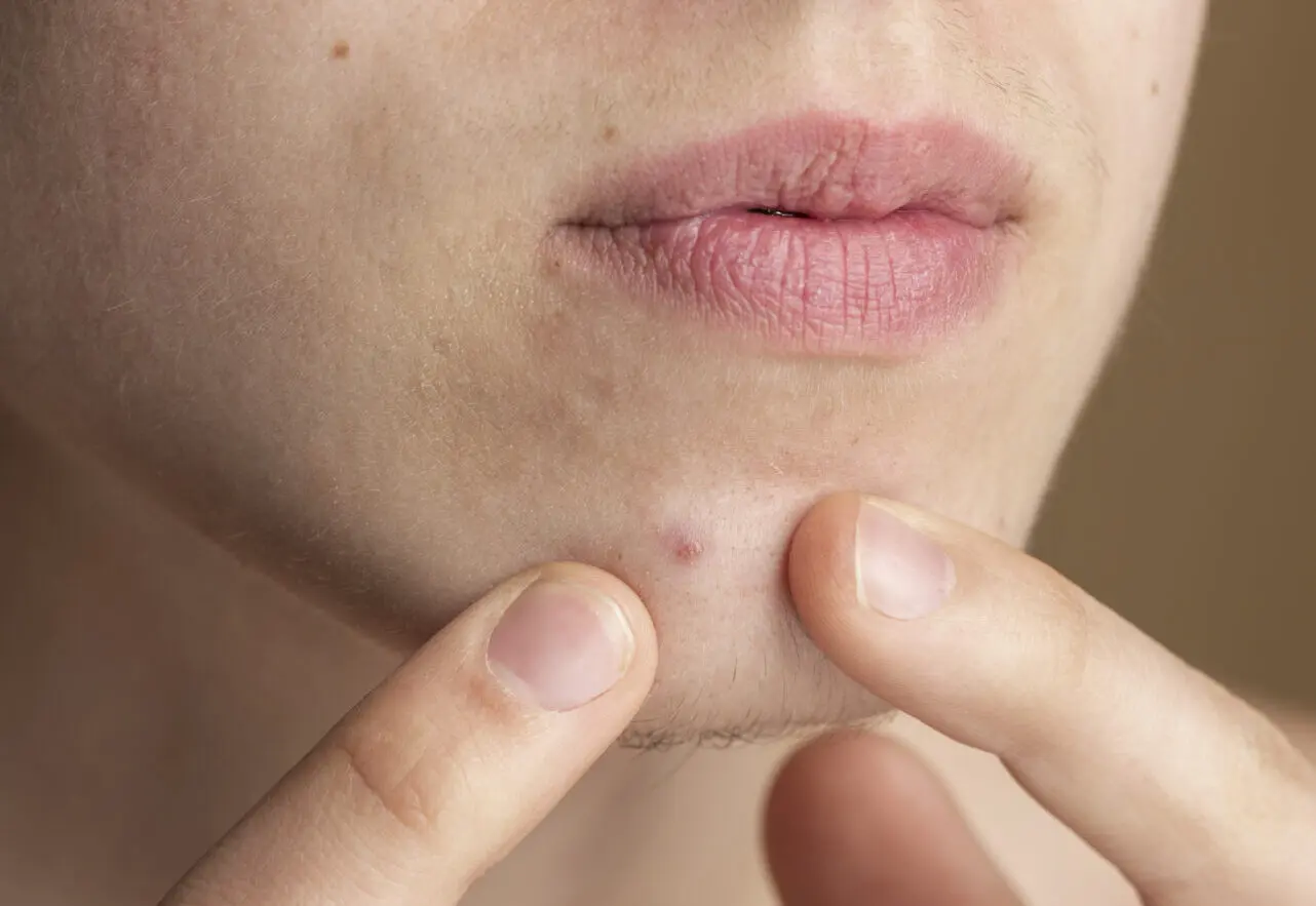 O que é a celulite facial