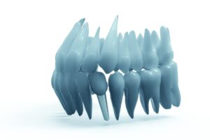 Implantes dentários mitos e verdades que você precisa saber