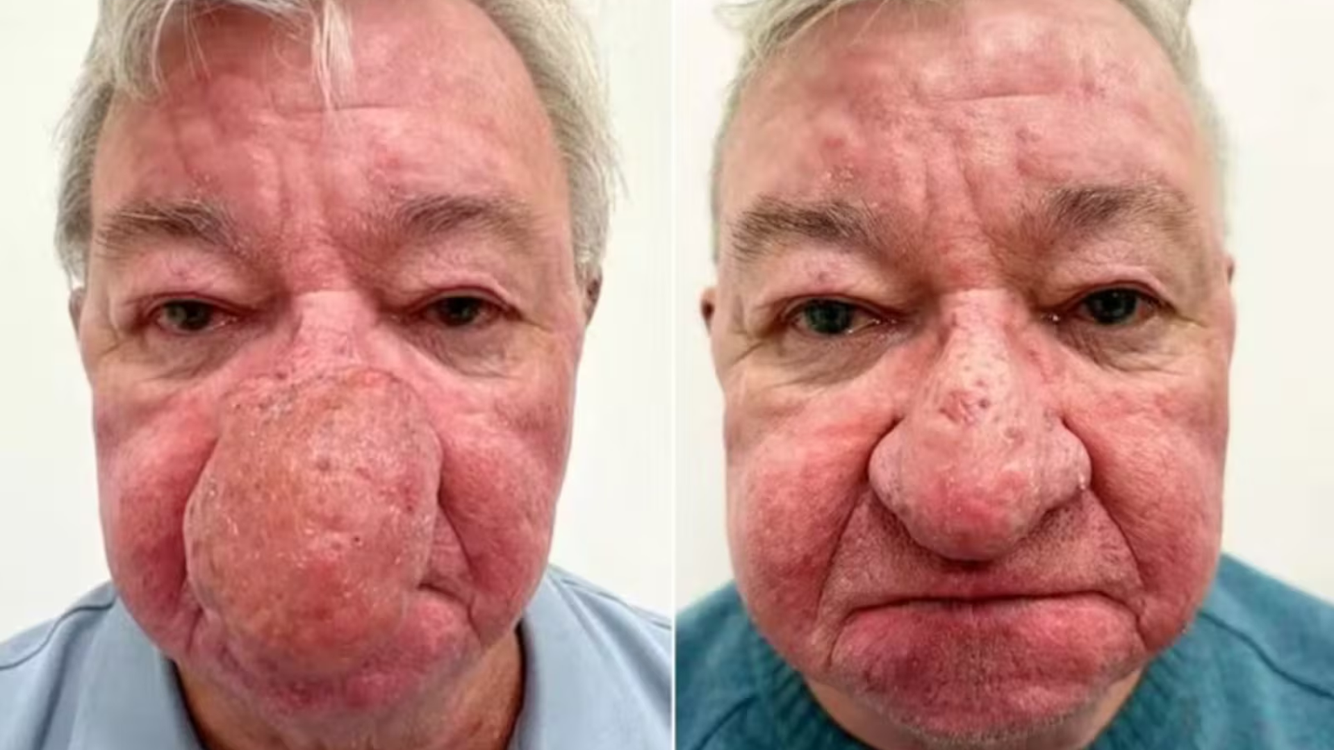 Escocês recupera autoestima após cirurgia que o permitiu beijar a esposa novamente