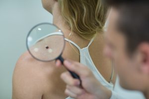 Dermatologist examining mole with magnifying glass in clinic