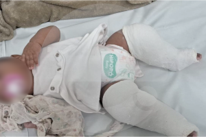 Bebê de quatro meses é internada com múltiplas fraturas e caso investigado pela polícia de Limeira