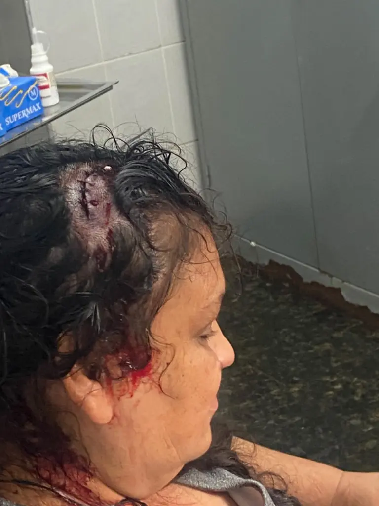 Mulher ferida após queda de cobertura de ponto de ônibus recebe atendimento em casa