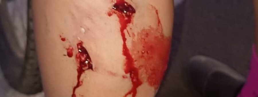 Ciclista é atacada por pitbull solto próximo ao CR em Limeira