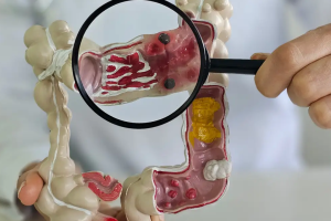 Em 13 anos, doença inflamatória intestinal cresce 5 vezes no Brasil