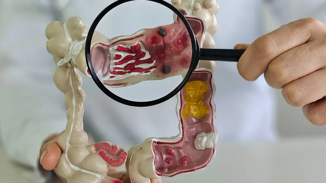 Em 13 anos, doença inflamatória intestinal cresce 5 vezes no Brasil
